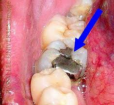 Dental Mercury